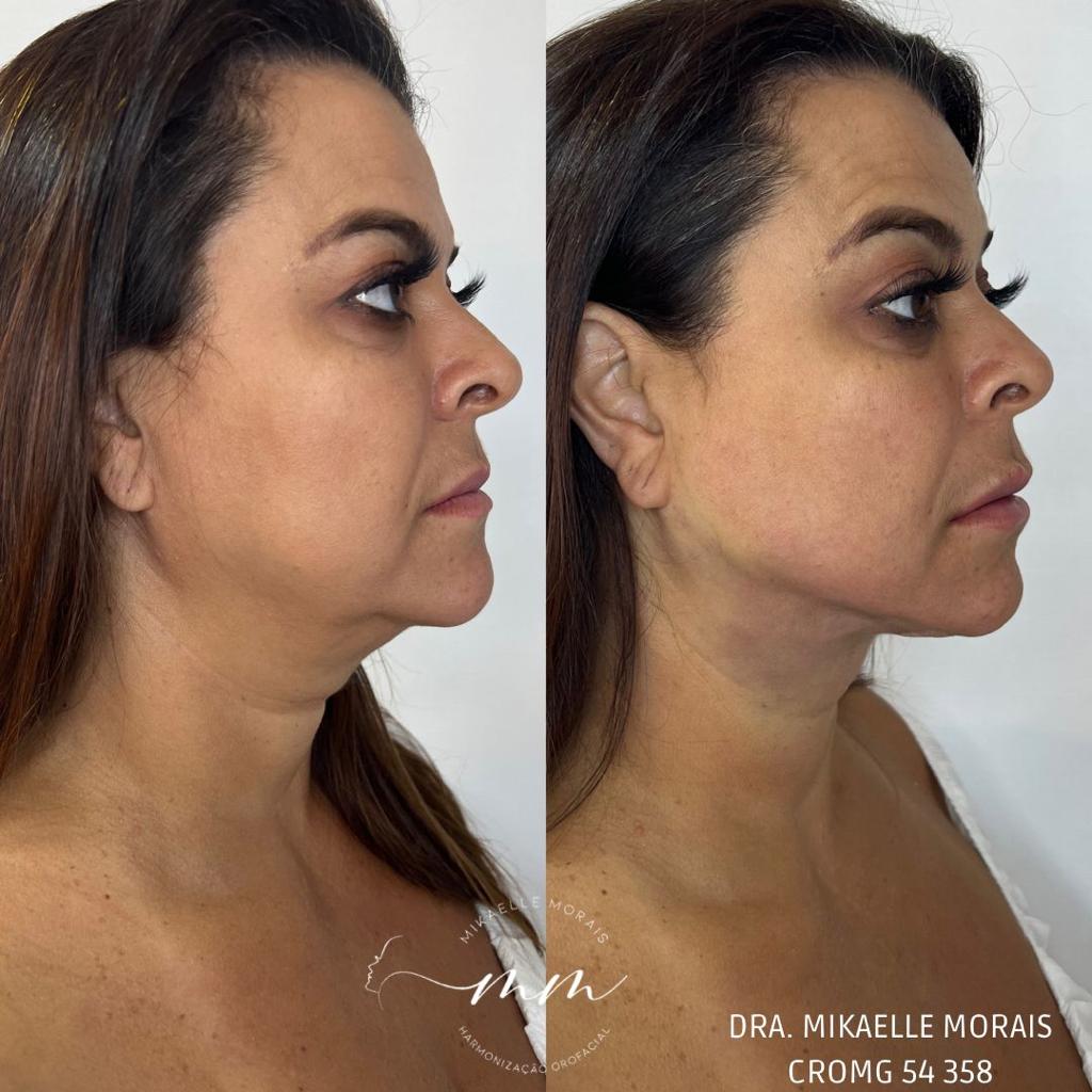 Lipo de Papada
